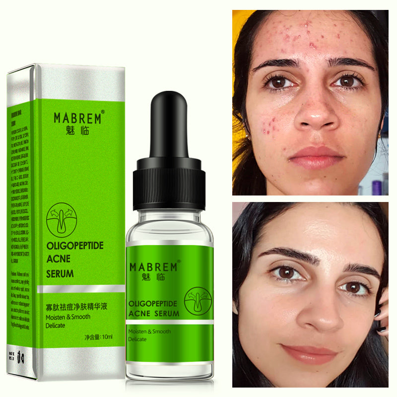 MABREM OLIGOPEPTIDE ACNE SERUM